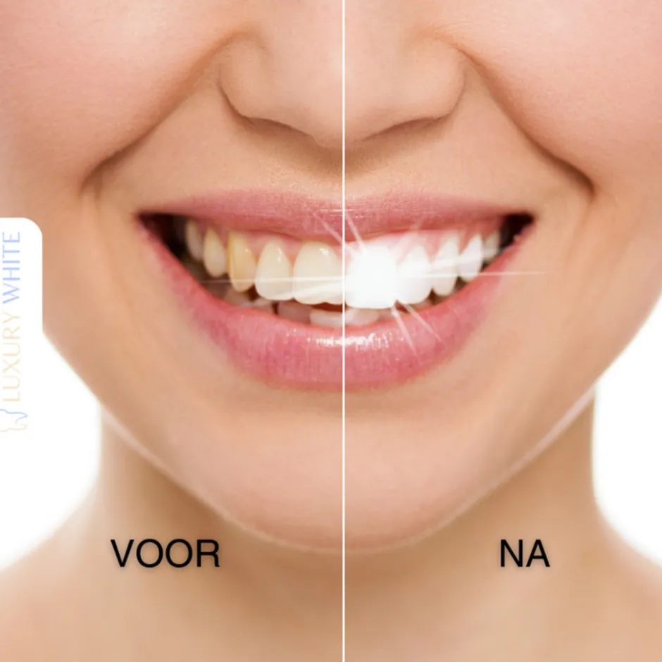 Luxury White Starter Kit< Whitening Producten